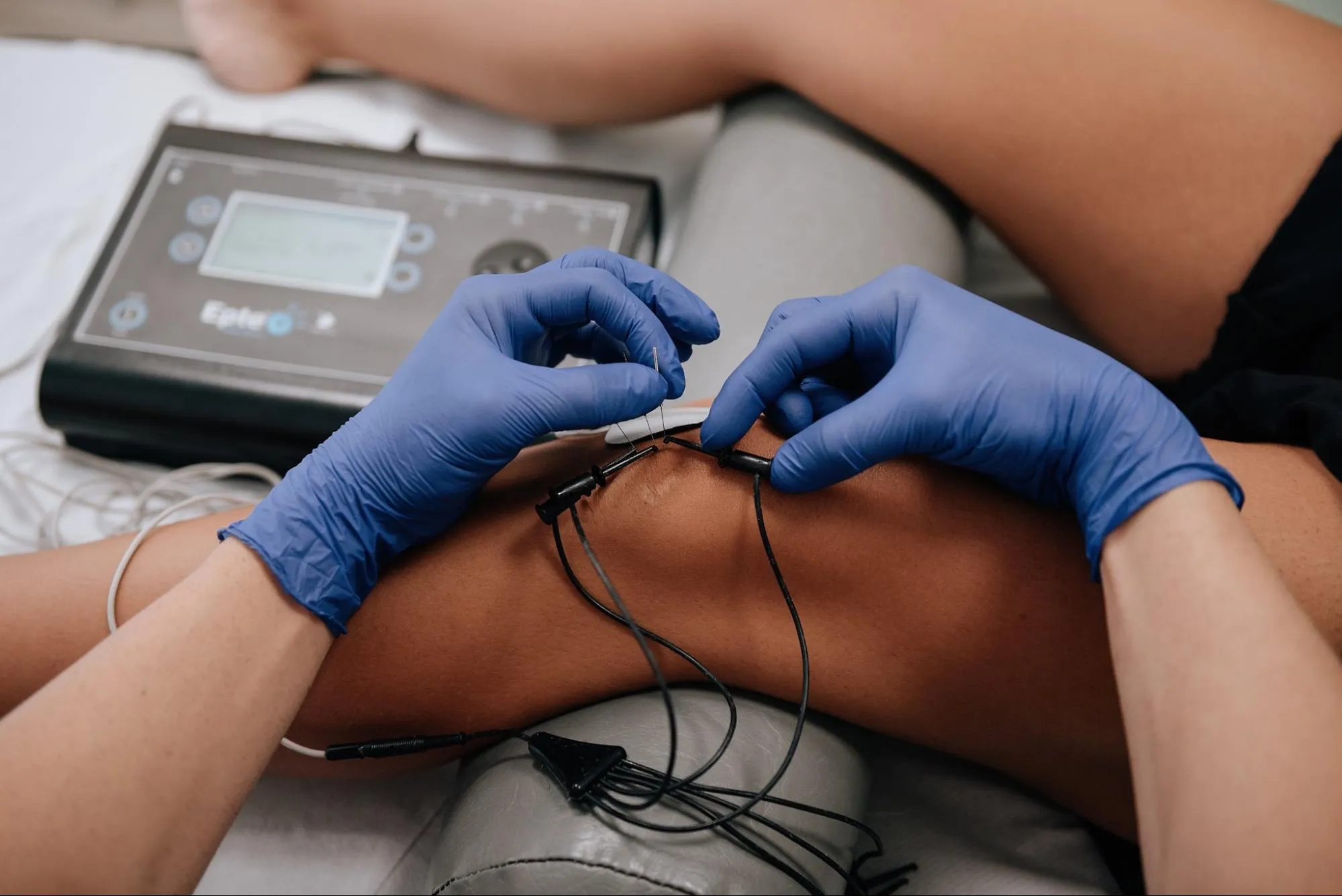 Electrólisis percutánea: EPI / EPTE