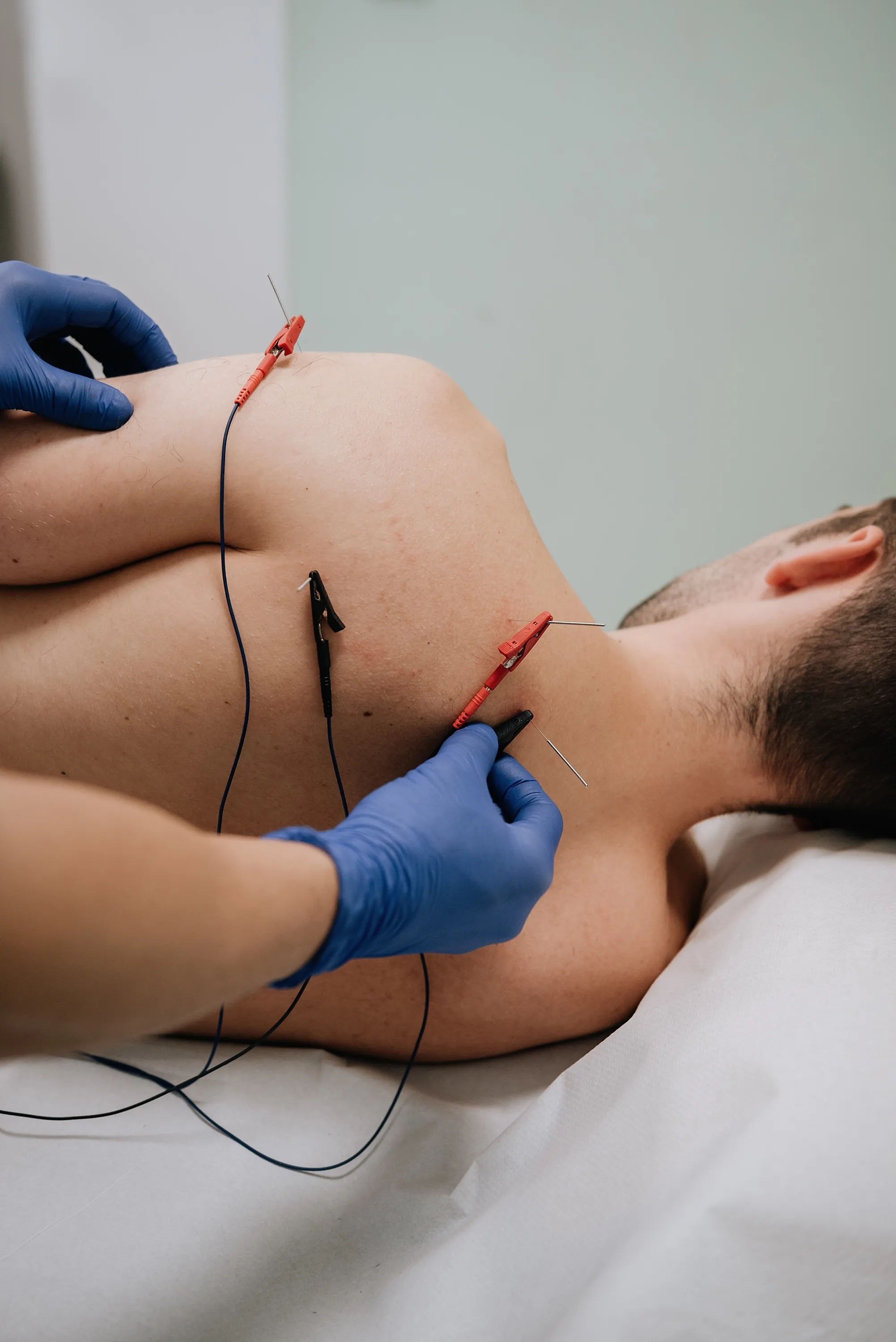 Neuromodulación percutánea: NMP